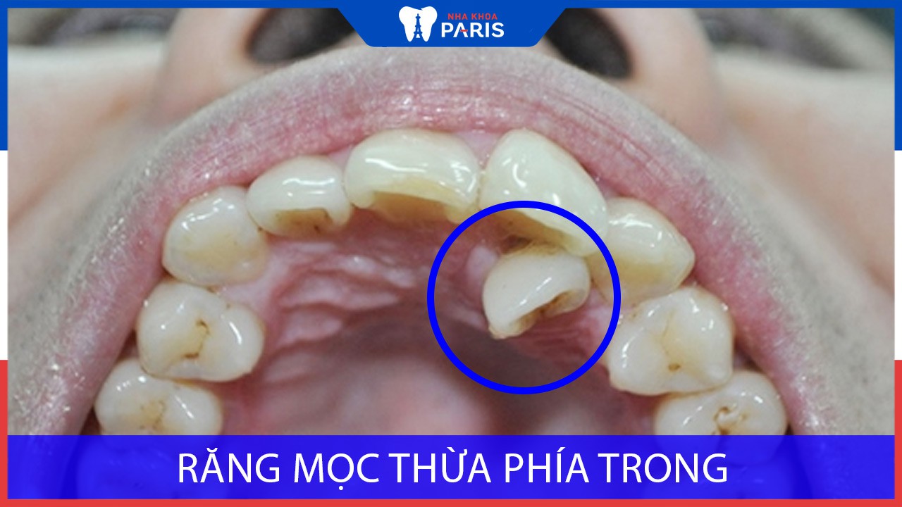 Răng mọc thừa phía trong có nguy hiểm? Có nên nhổ bỏ răng không?